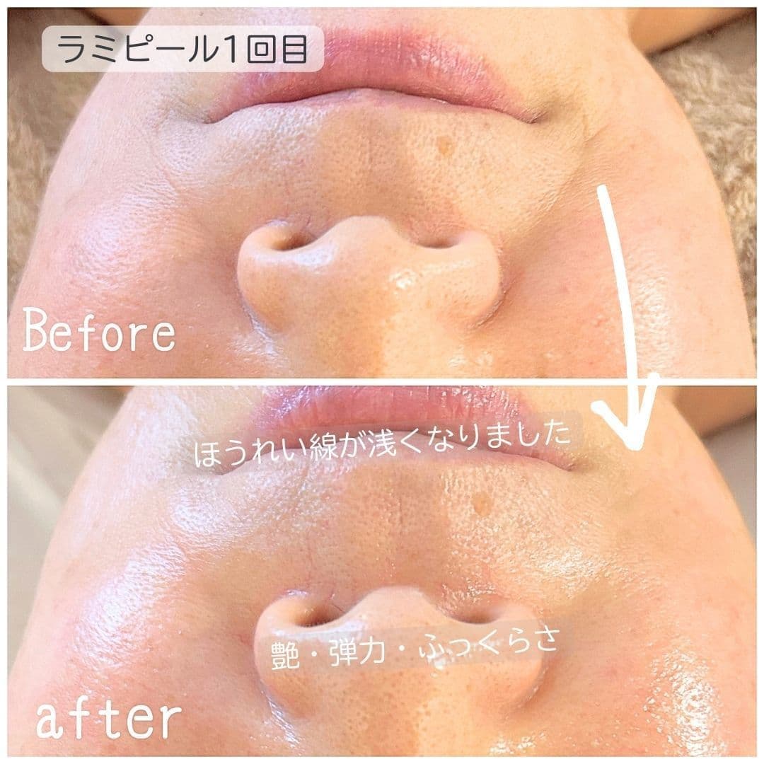 ラミネーションピール